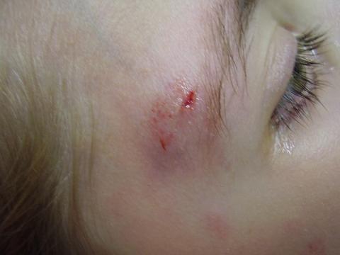 She fell, face first, in one of the less grassy areas of the yard. Why?